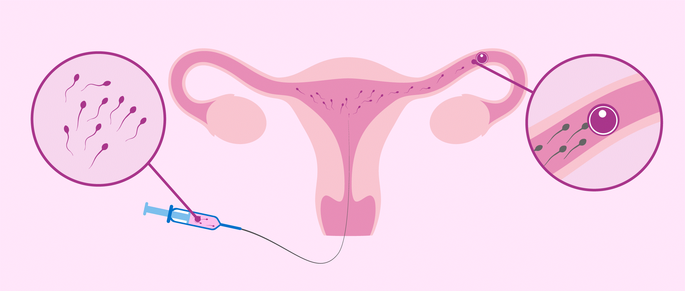 процедура введения спермы в матку фото 12